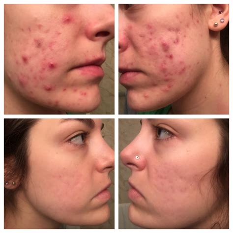 Can I take vitamin D with Accutane?