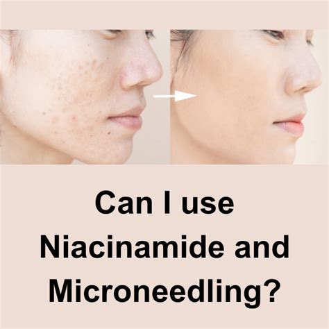 Can I use niacinamide after steaming?