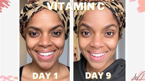 Can I use vitamin C serum after Botox?