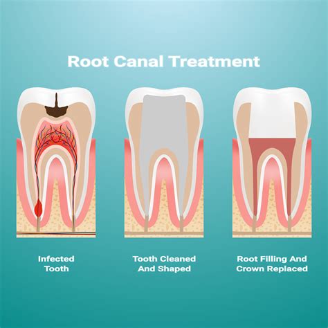 Can I wait 4 months for a root canal?