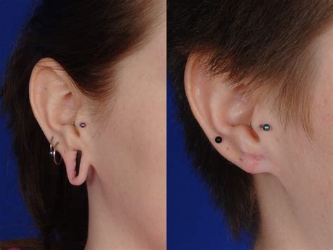 Can I wear earrings after ear lobe repair?