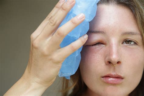 Can Ice cure sore eyes?