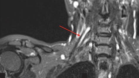 Can MRI detect nerve damage in the brain?