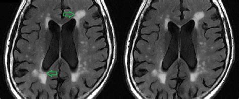 Can MRI show old brain injury?