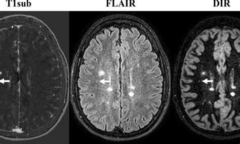 Can MS be missed on MRI without contrast?