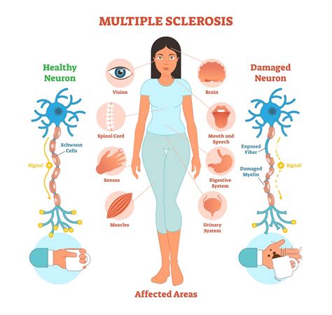 Can MS symptoms vary from day to day?