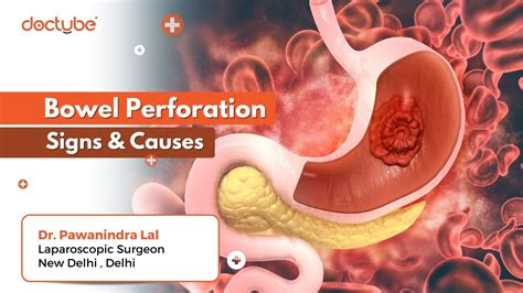 Can NGT cause bowel perforation?
