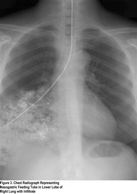 Can NGT lead to pneumonia?