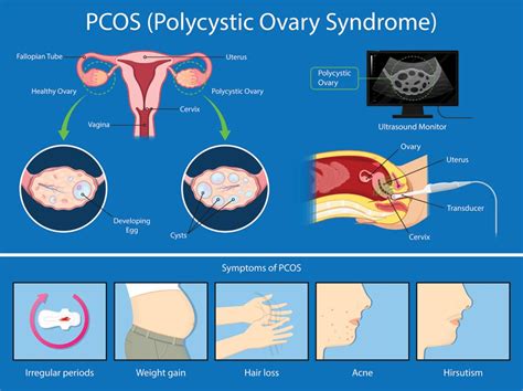 Can PCOS cause black period?