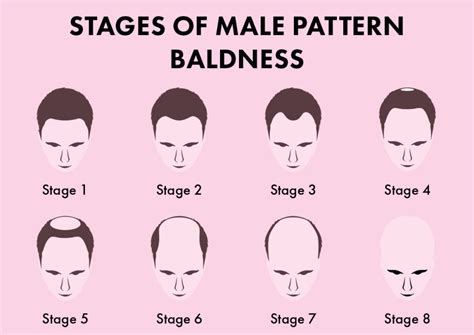 Can Stage 1 baldness be cured?