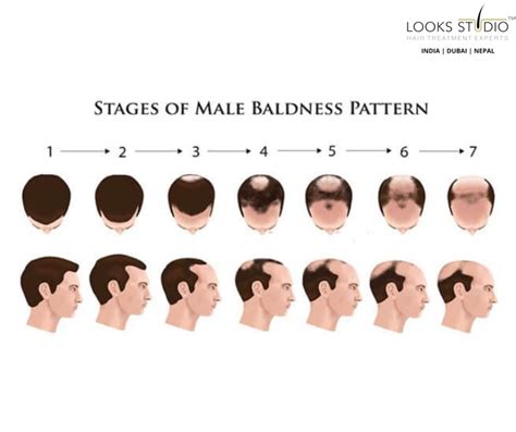 Can Stage 3 baldness be cured?