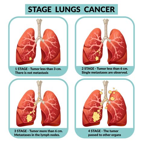 Can Stage 4 lung cancer be cured?