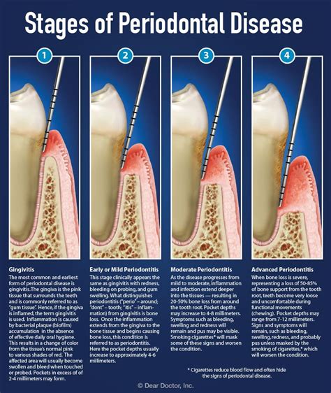 Can Stage 4 periodontal disease reversed?