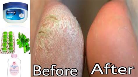 Can Vaseline heal cracked heels?