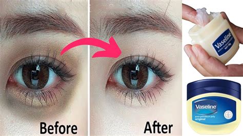 Can Vaseline remove dark circles?