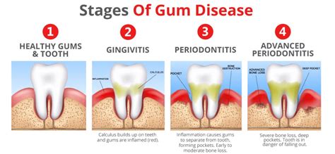 Can a 14 year old get gum disease?