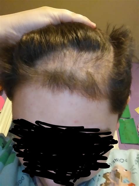 Can a 14 year old start balding?