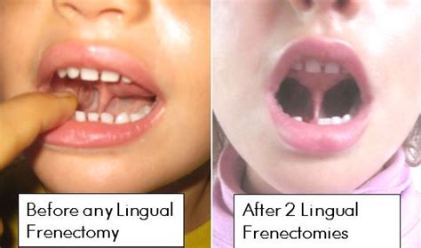 Can a 17 year old get a frenectomy?
