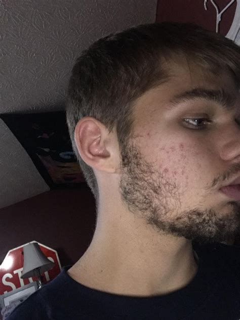 Can a 17 year old use Beard Oil?