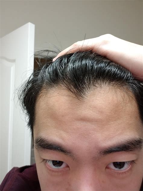 Can a 19 year old have a receding hairline?