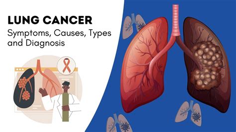 Can a 24 year old get lung cancer?