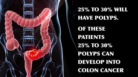 Can a 25 mm polyp be cancerous?