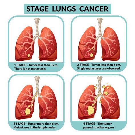 Can a 26 year old get lung cancer?