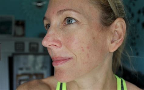 Can a 70 year old get acne?