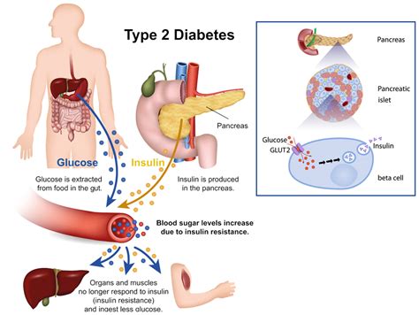 Can a Type 2 diabetic survive without insulin?