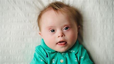Can a baby have Down syndrome and not look like it?