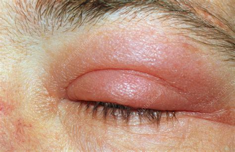 Can a bacterial eye infection come back?