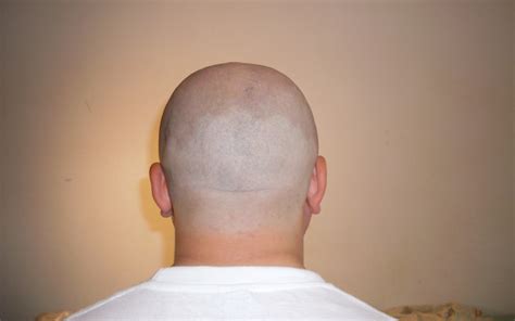 Can a bald head regrow hair?