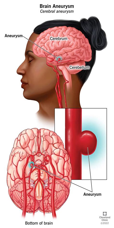 Can a brain aneurysm go undetected?