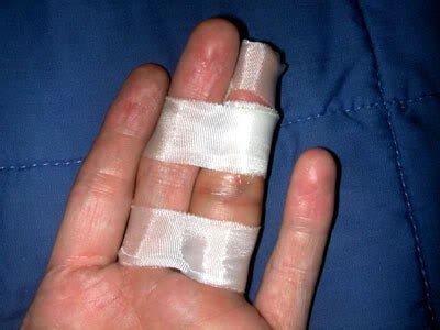 Can a broken finger be fixed after a month?