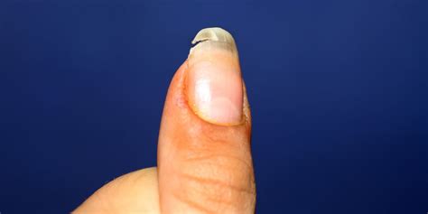 Can a broken nail heal itself?
