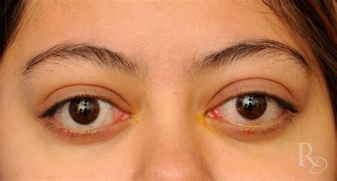 Can a bulging eye go back to normal?