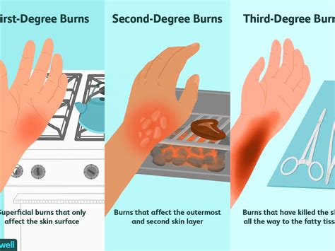 Can a burn go away overnight?