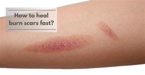 Can a burn take months to heal?