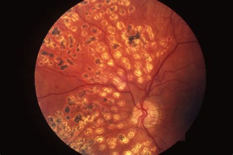 Can a burned retina heal?