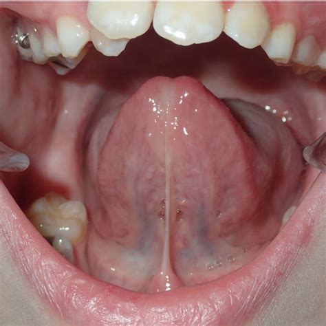 Can a cut tongue-tie grow back?