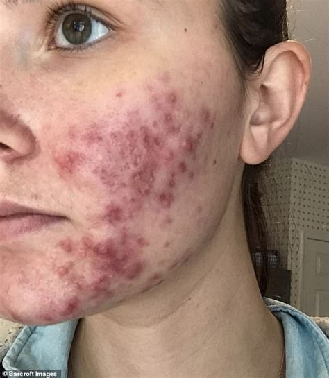Can a cystic pimple last for months?