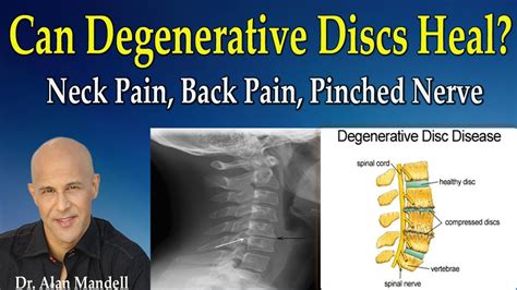 Can a degenerative disc ever heal?