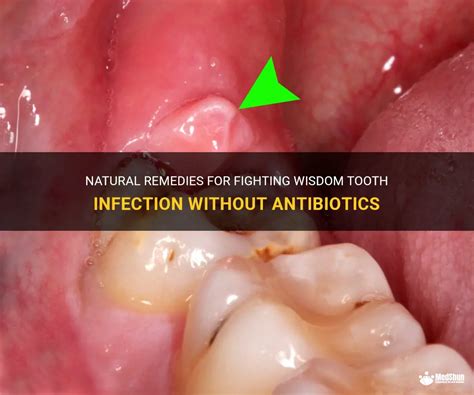 Can a dental infection heal without antibiotics?