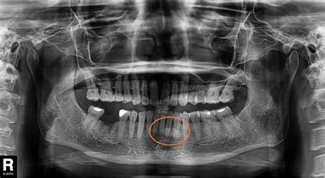 Can a dental xray see oral cancer?