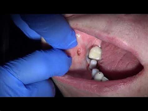 Can a dentist remove a fibroma?