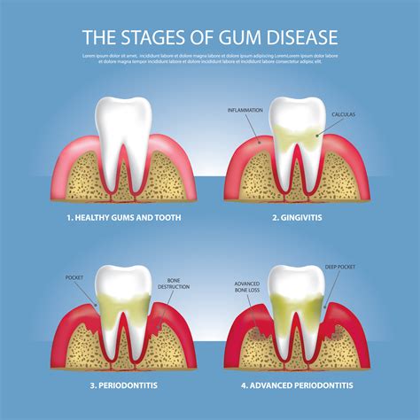 Can a dentist stop gum disease?