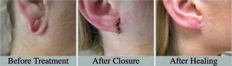 Can a dermatologist fix ripped earlobe?