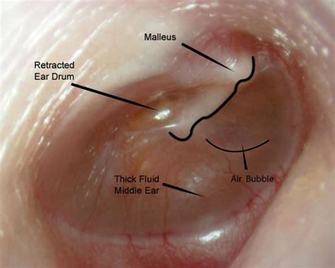 Can a doctor see fluid behind eardrum?