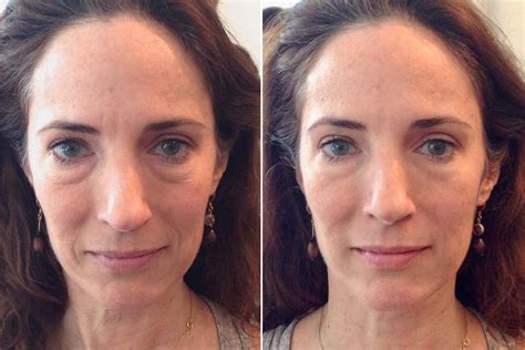 Can a face massage move Botox?