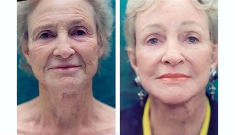 Can a facelift make you look 20 years younger?